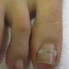 nagelbeugel 2